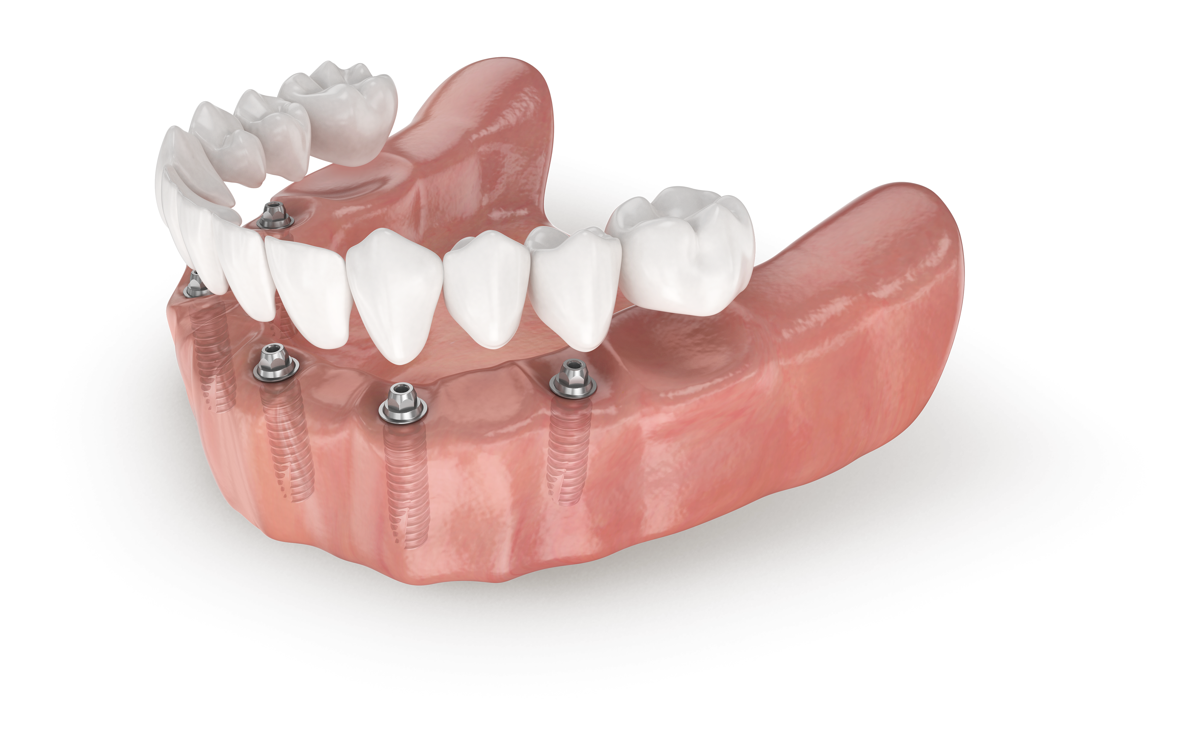 Несъемный зубной протез на 4 имплантах цена