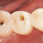 The crown block on the sites of teeth 45 and 46 before occlusal closure.