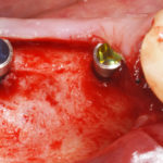 A 2.9 mm and a 3.5 mm BioniQ Plus implant was inserted at the sites of teeth 45 and 46, respectively, with the smooth neck area after periosteal flap formation.