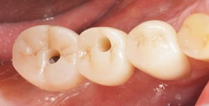 The crown block on the sites of teeth 45 and 46 before occlusal closure.