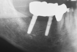Control X-ray taken after 14 months.